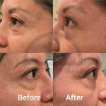Skin Tightening